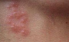 <b>珠海带状疱疹的危害有哪些</b>