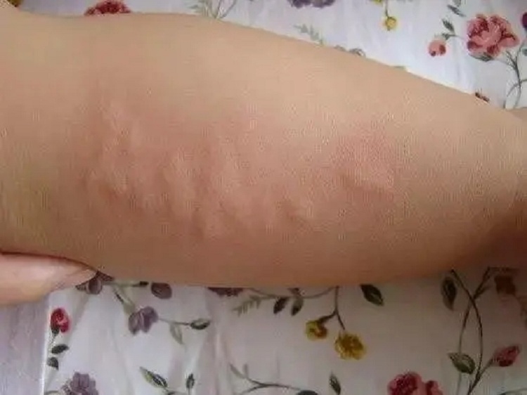 珠海哪个皮肤病医院治荨麻疹专业,珠海广肤皮肤科